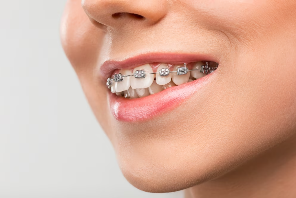 Invisalign Aligners vs. Traditional Braces: Which Is Right For You?